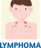 Lymphoma